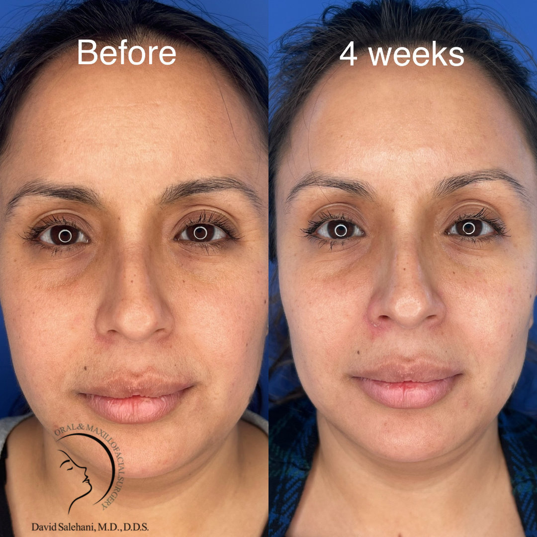 Side-by-side photos of a woman’s face showing skin and lip appearance before and four weeks after an AccuTite procedure. Procedure performed at Sunset Oral and Facial Surgery by David Salehani, D.D.S., M.D.