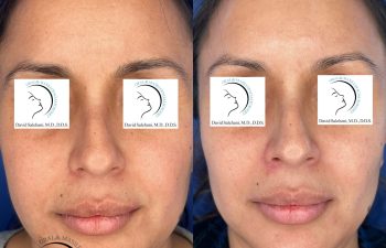 Side-by-side photos of a woman’s face showing skin and lip appearance before and four weeks after an AccuTite procedure, with eyes covered by a logo. Procedure performed at Sunset Oral and Facial Surgery by David Salehani, D.D.S., M.D.