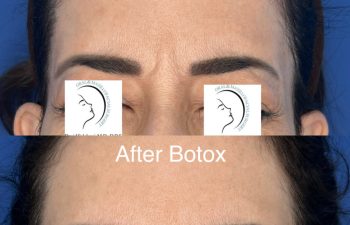 Close-up of a woman’s forehead showing pronounced wrinkles before Botox in the top image and smoother skin after Botox in the bottom image. Eyes are covered with a logo for privacy. Procedure performed at Sunset Oral and Facial Surgery by David Salehani, D.D.S., M.D.