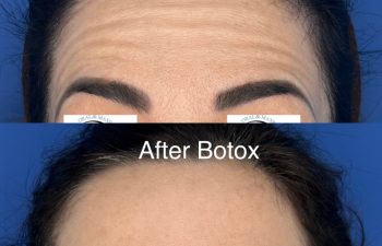 Close-up of a forehead before and after Botox treatment; the “before” image shows visible horizontal wrinkles, while the “after” image reveals a smoother, wrinkle-free forehead. Procedure performed at Sunset Oral and Facial Surgery by David Salehani, D.D.S., M.D.