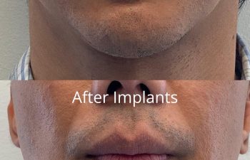 A comparison of a man’s face showing the chin and lower face before and after receiving facial implants; the after image shows a fuller, more defined chin. Procedure performed at Sunset Oral and Facial Surgery by David Salehani, D.D.S., M.D.
