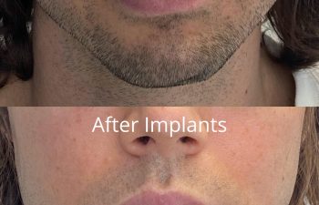 Close-up comparison of the lower face showing a man’s chin and jawline before and after receiving implants, highlighting a more defined jaw and chin in the “after” image. Procedure performed at Sunset Oral and Facial Surgery by David Salehani, D.D.S., M.D.