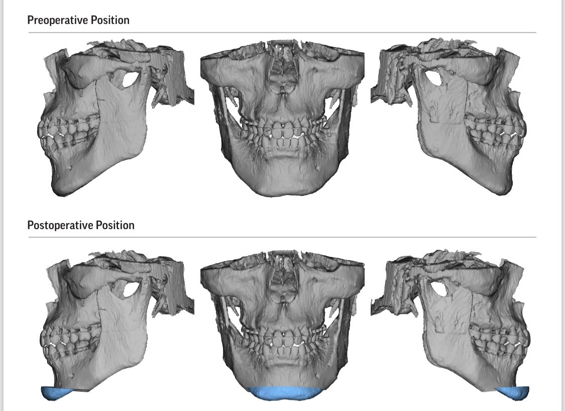 3D scans of a skull showing preoperative (top) and postoperative (bottom) positions from three angles, with the lower jaw area highlighted in blue postoperatively.