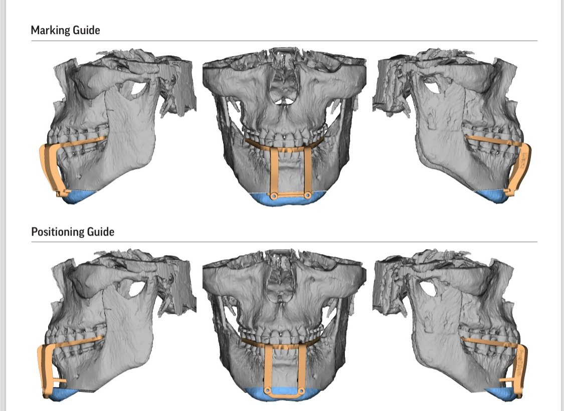 Digital renderings of a human skull show two views: the top row labeled "Marking Guide" and the bottom row labeled "Positioning Guide," each with surgical guides attached to the jaw.