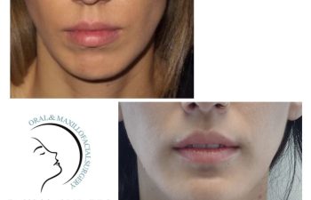 Side-by-side before and after images showing a woman's lower face and mouth area, illustrating changes following an oral and maxillofacial surgery procedure.