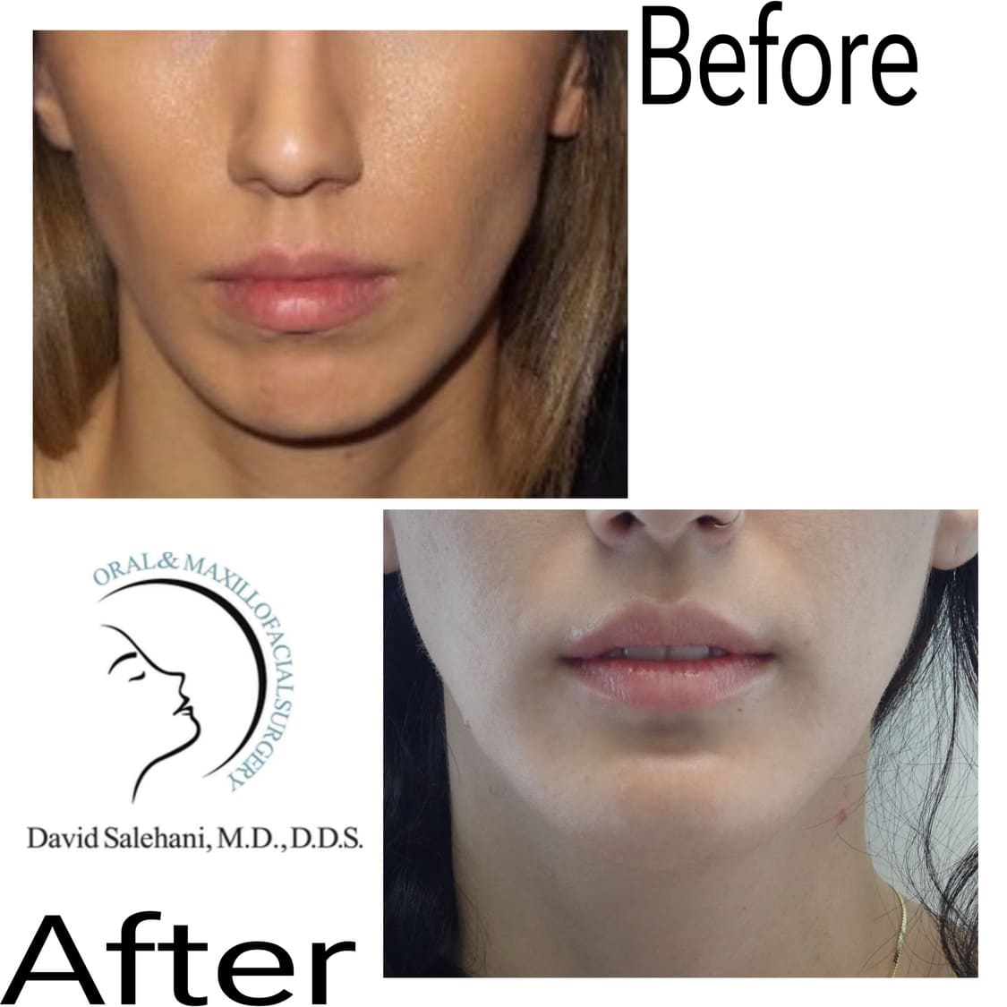 Side-by-side before and after images showing a woman's lower face and mouth area, illustrating changes following an oral and maxillofacial surgery procedure.
