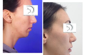 Side-by-side profile photos of a woman labeled "Before" and after a cosmetic procedure, showing changes to her chin and jawline.