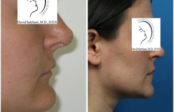 Side-by-side profile photos of a woman before and after reduction genioplasty, showing noticeable reduction in chin projection after surgery.