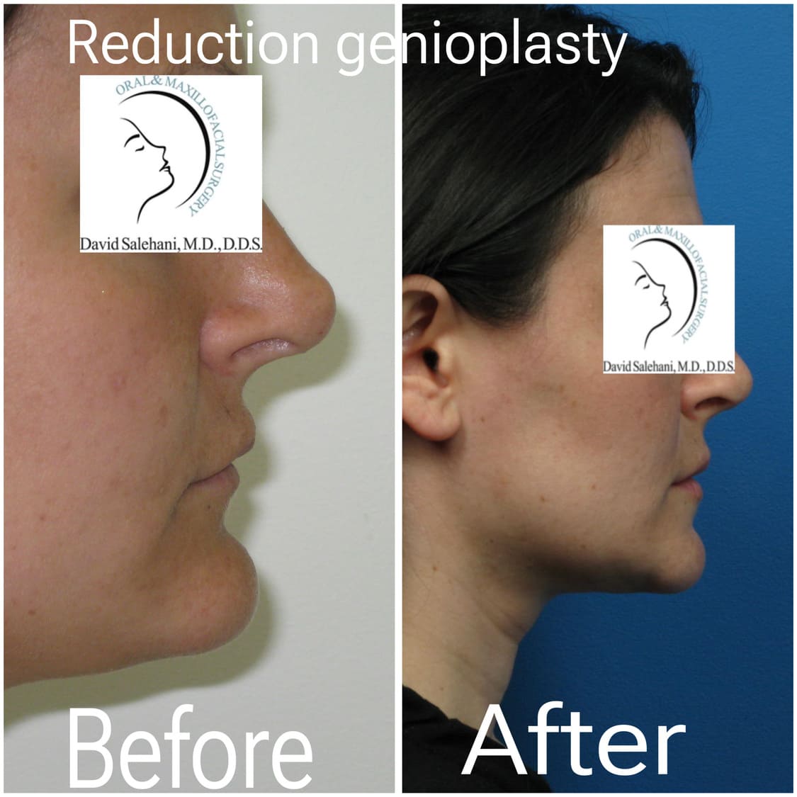 Side-by-side profile photos of a woman before and after reduction genioplasty, showing noticeable reduction in chin projection after surgery.
