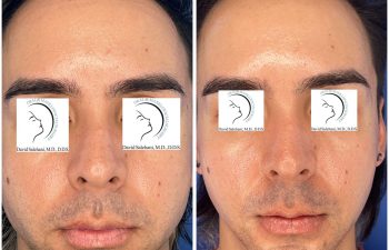 Before and after frontal view of a male patient following advancement genioplasty