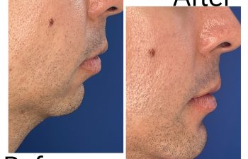 Before and after right-side profile view of a male patient following advancement genioplasty